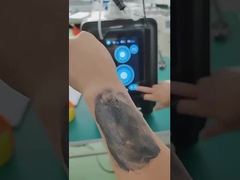 Perangkat P9 Nd Yag Laser Picosecond Laser Tattoo Removal