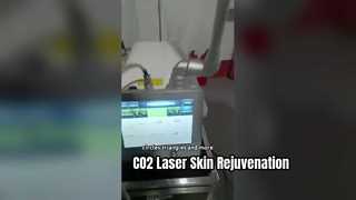 30W RF Tube Fractional Co2 Laser untuk Penghapusan Paru-paru dan Peningkatan Tekanan Kulit