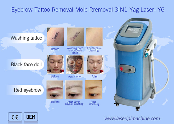 1064nm / 532nm Nd Yag Laser Mesin Penghapusan Tato Dermatologi